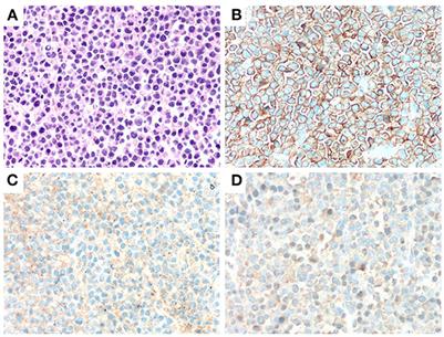 Case reports: Central nervous system involvement in patients with newly diagnosed multiple myeloma